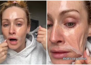 Σάλος με μάσκα «skincare»: Influencer «σφάδαζε» απ’ τον πόνο κατά την αφαίρεση της (vid)