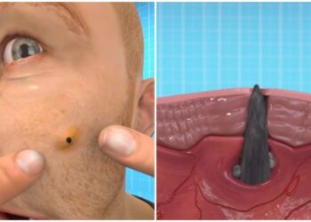 Σπυράκια και μαύρα στίγματα: Αηδιαστική προσομοίωση δείχνει γιατί δεν πρέπει να τα σπάτε (vid)