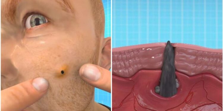 Σπυράκια και μαύρα στίγματα: Αηδιαστική προσομοίωση δείχνει γιατί δεν πρέπει να τα σπάτε (vid)